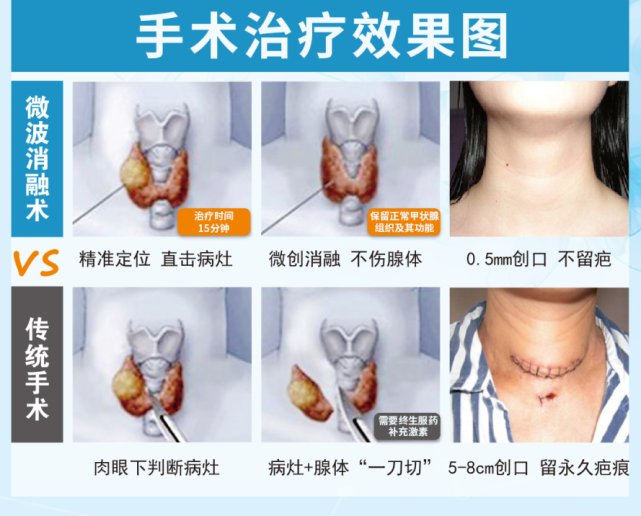 结节|微波消融甲状腺结节安全吗?你关心的问题都在这里了! 健身|样本量|体育|驿站|中心